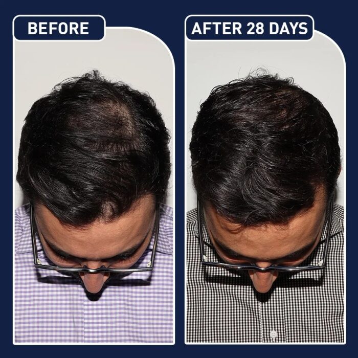 ⁦البخاخ الأمريكي لنمو الشعر FEG⁩ - الصورة ⁦5⁩