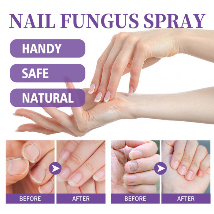 ⁦• NAIL FANGUS SPRAY⁩ - الصورة ⁦14⁩
